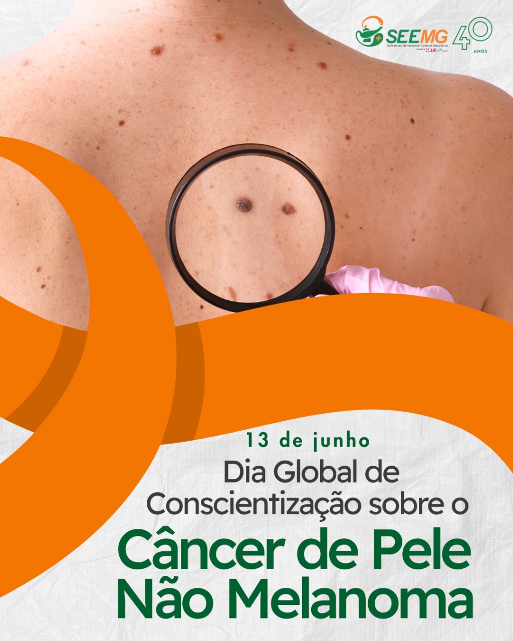 13/06 - Dia Global de Conscientização sobre o Câncer de Pele Não Melanoma